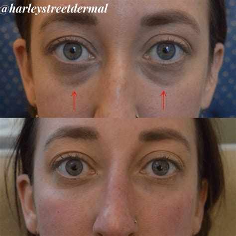 Dark Circles Treatment In London Harley Street Dermal