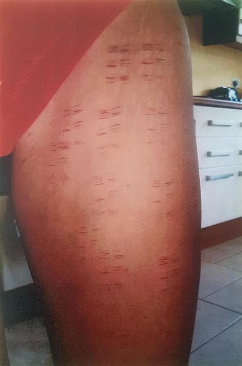 Woman Who Suffered First And Second Degree Burns On Thighs After Laser