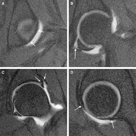 Acetabular Labrum Anatomy Human Anatomy B