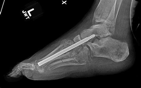 Tibiotalocalcaneal Fusion The Foot And Ankle Online Journal