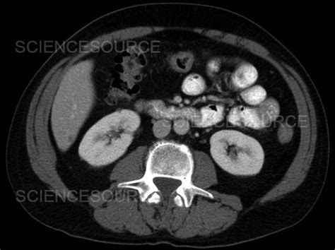 Photograph | Liver metastases, CT scan | Science Source Images