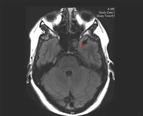 Sphenoid Sinus Mri