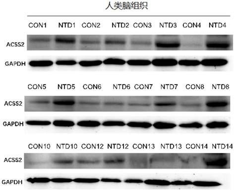 生物标志物的检测产品在制备辅助诊断、诊断或预后评判神经管畸形的产品中的用途的制作方法