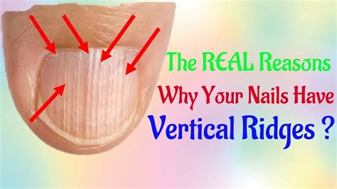 The Real Reasons Why Your Nails Have Vertical How To Treat And Fix