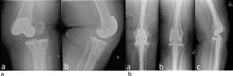 Satisfactory Medium To Long Term Outcomes Of Cemented Rotating Hinge