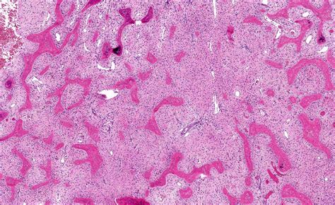 Polyostotic Fibrous Dysplasia Of Bone