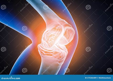 Human Knee Joint And Bones With Inflammation Injury Or Pain D