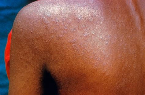 Maculopapular Rash Syphilis