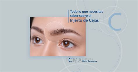 Injerto De Cejas Todo Lo Que Necesitas Saber Explicado Por El Dr Mato