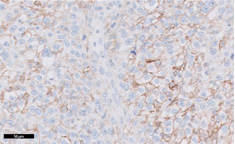 Pd L Ihc C Pharmdx Demonstrates Precision And Reproducibility In