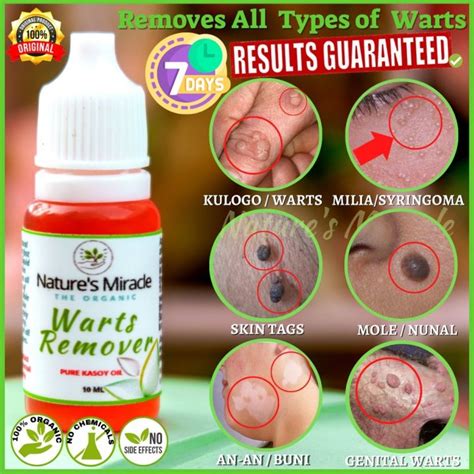 Warts Remover Kasoy Oil Warts Remover Original Mole Remover Kulogo Buni