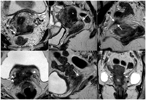 Jcm Free Full Text Ultrasound Of The Uterosacral Ligament