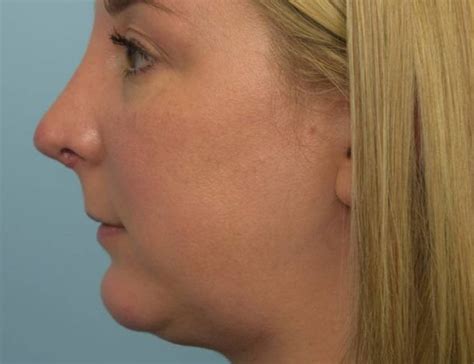 Before And After Revision Rhinoplasty Houston Face Forward