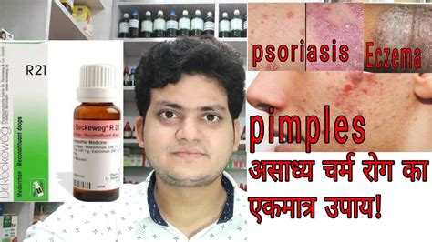 Homeopathic Medicine For Chronic Skin Diseases Psoriasis Eczema