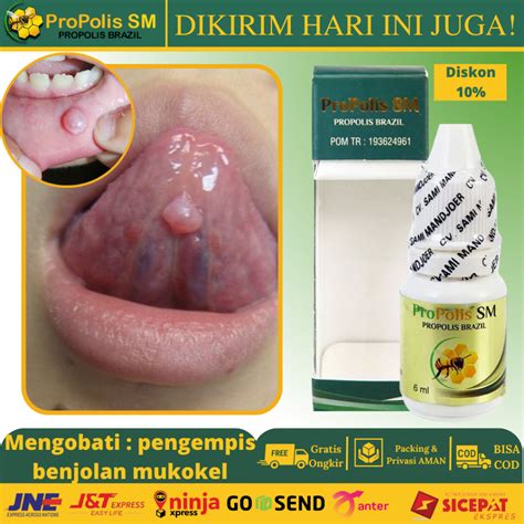 Jual Obat Mukokel Penghilang Benjolan Di Bawah Lidah Obat Benjolan Di Mulut Obat Abses Polip