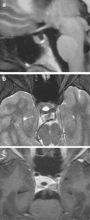 pars intermedia cyst sagittal twi   axial twi  shows