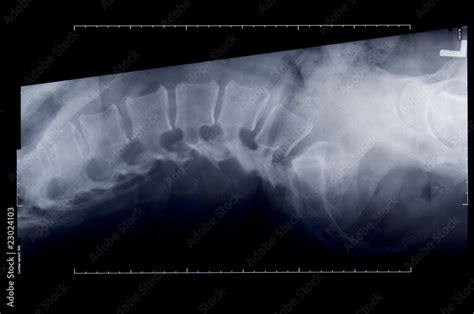 X-ray of spine Stock Photo | Adobe Stock