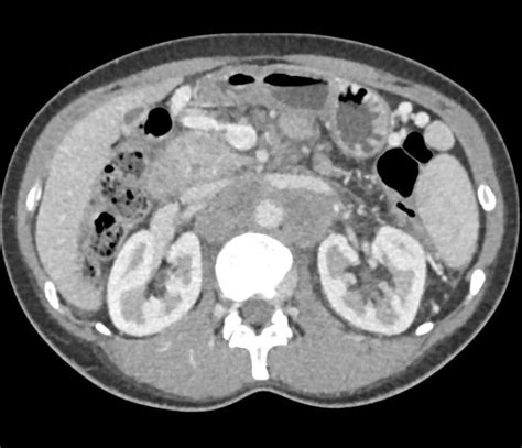 Pancreatic Adenocarcinoma With Extensive Adenopathy Liver Metastases