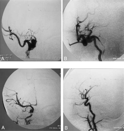 Figure 2 From Presentation And Treatment Direct Carotid Cavernous Fistula In Infancy Semantic