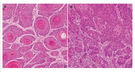 Figure 1 From Comparison Of Subtypes Of Penile Squamous Cell Carcinoma From High And Low