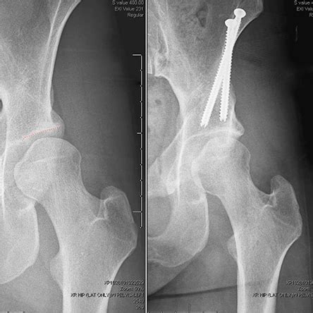 Periacetabular Osteotomy (PAO) - CU Sports Med Hip Clinic