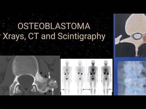 Osteoblastoma Radiology x ray. CT and Scintigraphy - YouTube