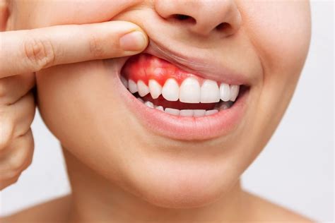 ¿sangran Tus Encías Te Contamos Por Qué I Clínica Dental Gramadent