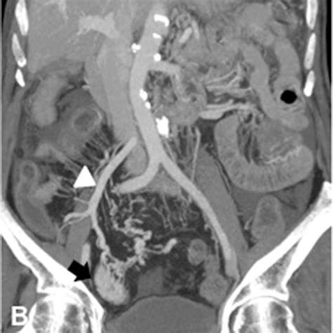 PDF Ileal Angiodysplasia Presentation As A Bowel Obstruction A Case