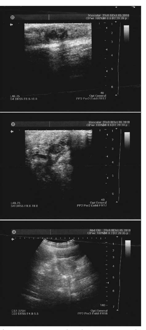 Figure From Clitoromegaly Caused By Cavernous Hemangioma A Rare Case