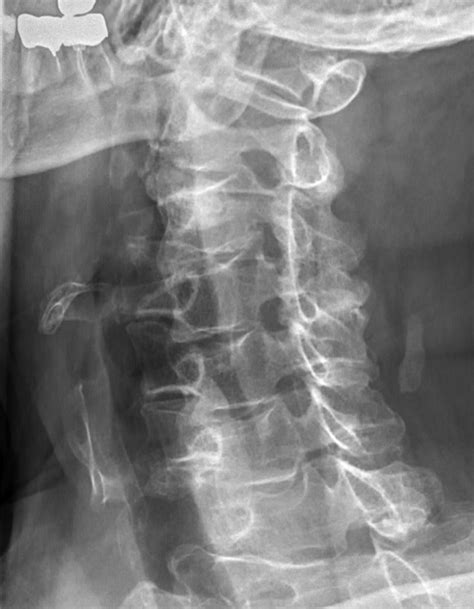 Cervical Radiculopathy X Ray