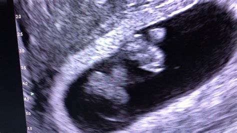 Ultrasound Pictures Of Identical Twins