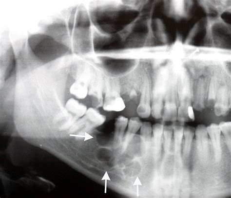 Unicystic Ameloblastoma Maxilla