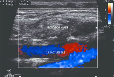 Ultrasound picture of hypoechoic mass involving muscle | Download Scientific Diagram