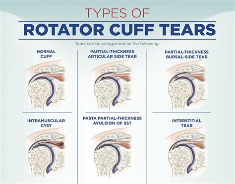 Rotator Cuff Injury Types