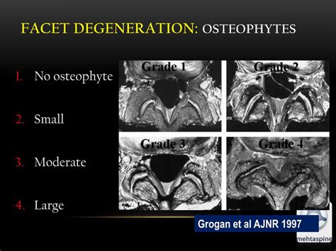 Ppt Spondylolisthesis Powerpoint Presentation Free Download Id1562640