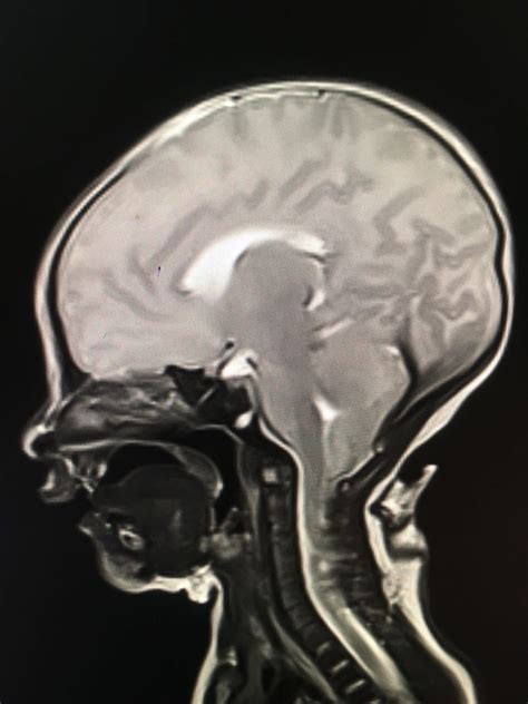 Tonsillar herniation- DWM | Imagenologia, Cosas de enfermeria, Enfermeria