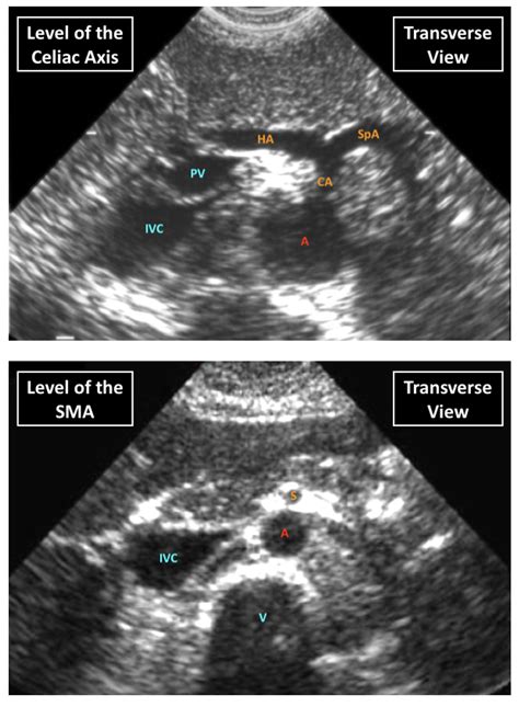 Ultrasound Of The Abdominal Aorta | EMcyclopedia