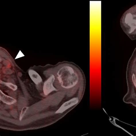 Figure5 Positron Emission Tomography Computed Tomography Image Showing