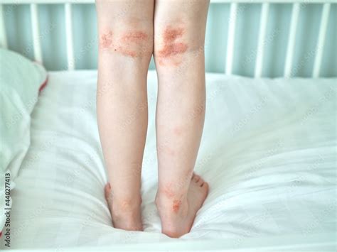 Eczema On Kid S Legs Atopic Dermatitis Close Up Allergy Spots And Red