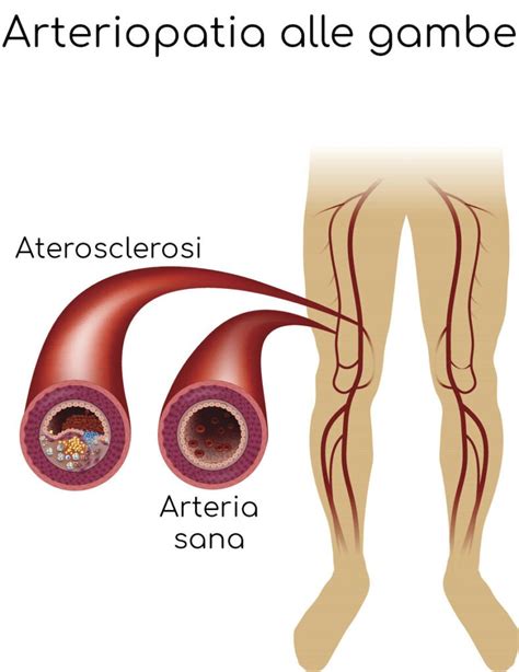 Claudicatio Intermittens Definizione Cause Sintomi E Cura Valori