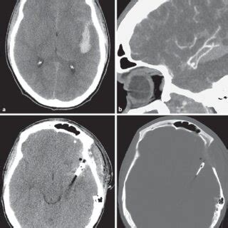 CT scan showing a subarachnoid hemorrhage (a) and a CT angiography ...