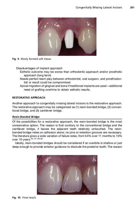 11 Lateral Incisors