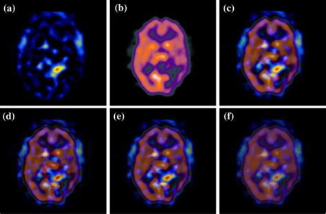 Fusion Results Of Image Set 3 A Source Image Spect T1 B Source Image Download Scientific