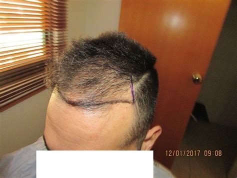 Hair Transplant Fue Result 0 8 Months Nw3 Hdc Hair Transplant