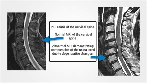 Spinal Cord Compression – Fact Versus Fiction