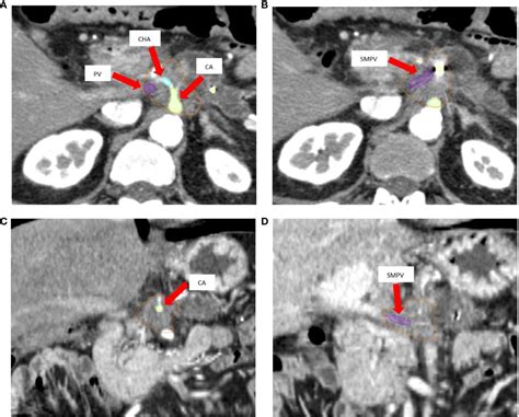 Frontiers Dosimetric Feasibility Study Of Dose Escalated Stereotactic