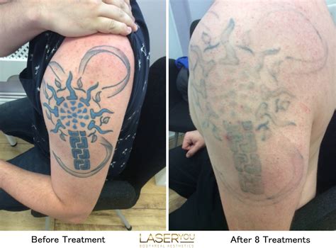 Discover More Than Picosure Laser Tattoo Removal Uk In Cdgdbentre