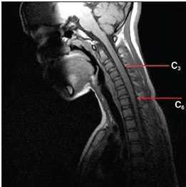 Neuromyelitis Optica Causes, Symptoms, Diagnosis and Treatment - Natural Health News