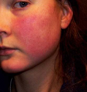 Acne Rosacea Symptoms - WelcomeCure