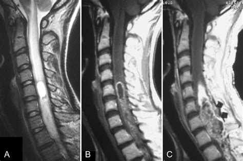 Intramedullary Spinal Cord Ependymoma And Astrocytoma Intraoperative